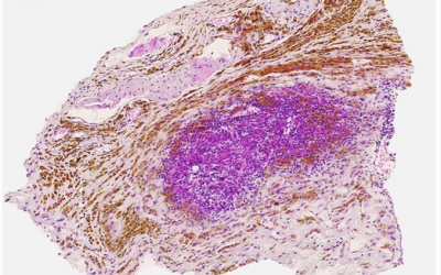 Un tratamiento nuevo contra el cáncer de páncreas estimula las defensas y frena el crecimiento tumoral en ratones